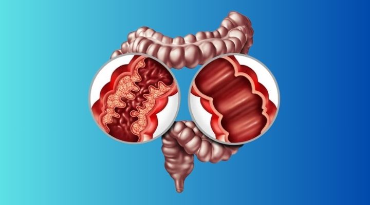 10 Unusual Signs of Colon Cancer